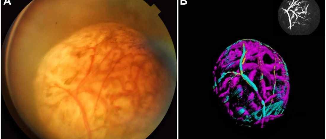 探索无色素脉络膜黑色素瘤双循环，《Ophthalmology》再现图湃3D血流魅力